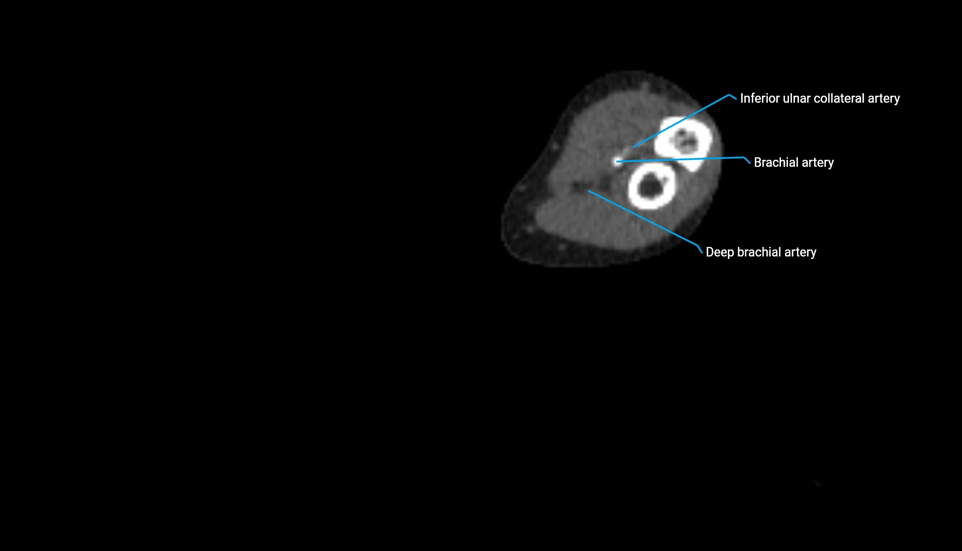 CTA upper limb axial cross sectional anatomy labelled image 173 (2).webp